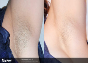 Laser Hair Removal Before and After Underarms 1 Treatment