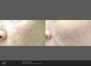 Laser Skin Resurfacing Icon Treatment Before After Acne Scar After 3 Treatments