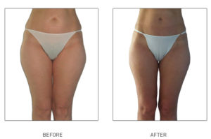 Cellulite Reduction Swindon, Cellulite Smoothing