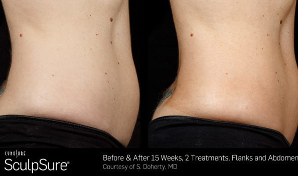 Before and After Sculpsure 25 minute, non-invasive fat removal treatment