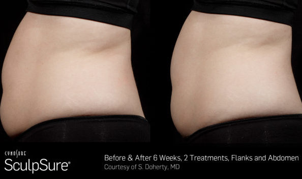 Before and After Sculpsure 25 minute, non-invasive fat removal treatment