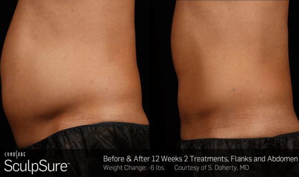 25 minute, non-invasive fat removal treatment Before and After Sculpsure