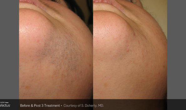 Laser Hair Removal Before and After Chin 3 Treatments