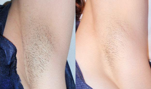 Laser Hair Removal Before and After Underarms 1 Treatment