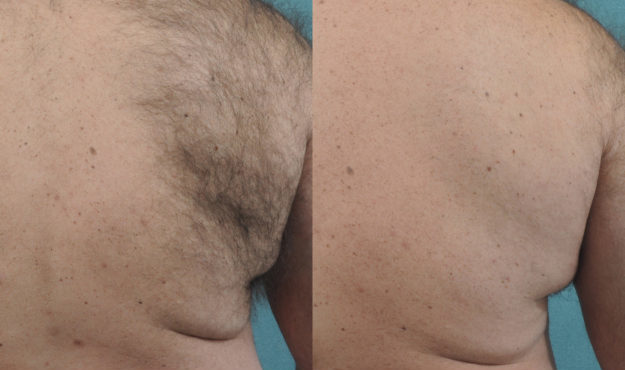 Laser Hair Removal Before and After Back 1 Treatment