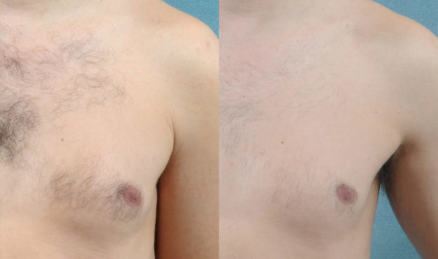 Laser Hair Removal Before and After Chest 1 Treatment