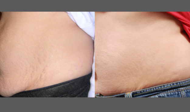 Icon Treatment Before After Stretch Marks Scar After 3 Treatments