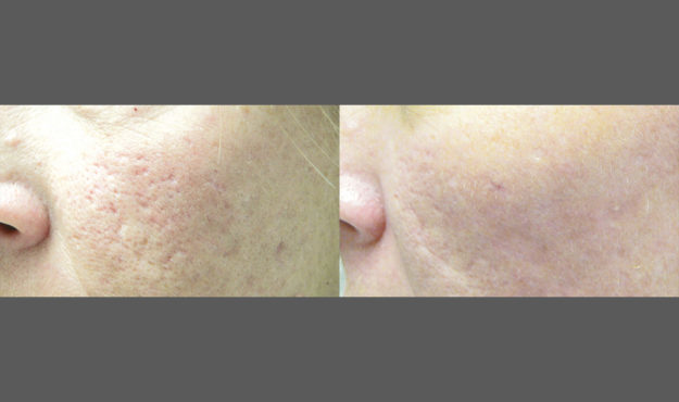 Icon Treatment Before After Acne Scar After 3 Treatments