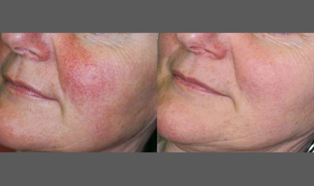 Icon Treatment Before After Rosacea