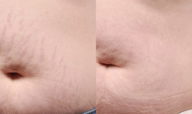 Icon Treatment Before After Stretch Marks Scar After 3 Treatments