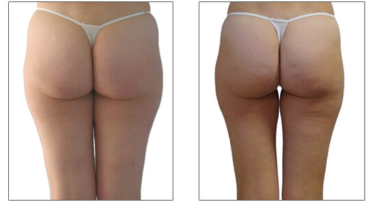 Endermologie Before After saddlebags, slims the stomach and thighs, smooths the look of cellulite 15 Sessions