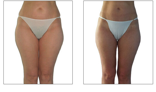 Endermologie Before After Saddlebags and Thigh Slimming 12 Sessions