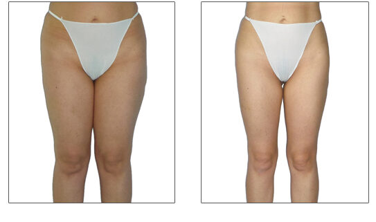 Endermologie Before after Thigh Slimming 12 sessions