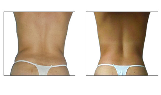 Endermologie Before After Back Slimming 10 Sessions