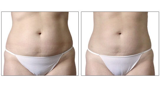 Endermologie Before After Stomach Slimming 5 Sessions
