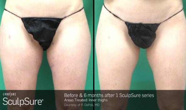 Before and After Inner Thighs SculpSure