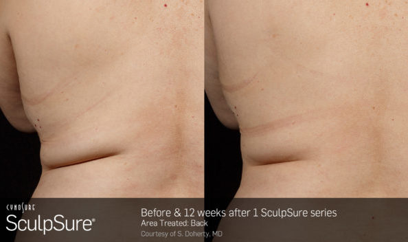 Before & After Back 1 Treatment